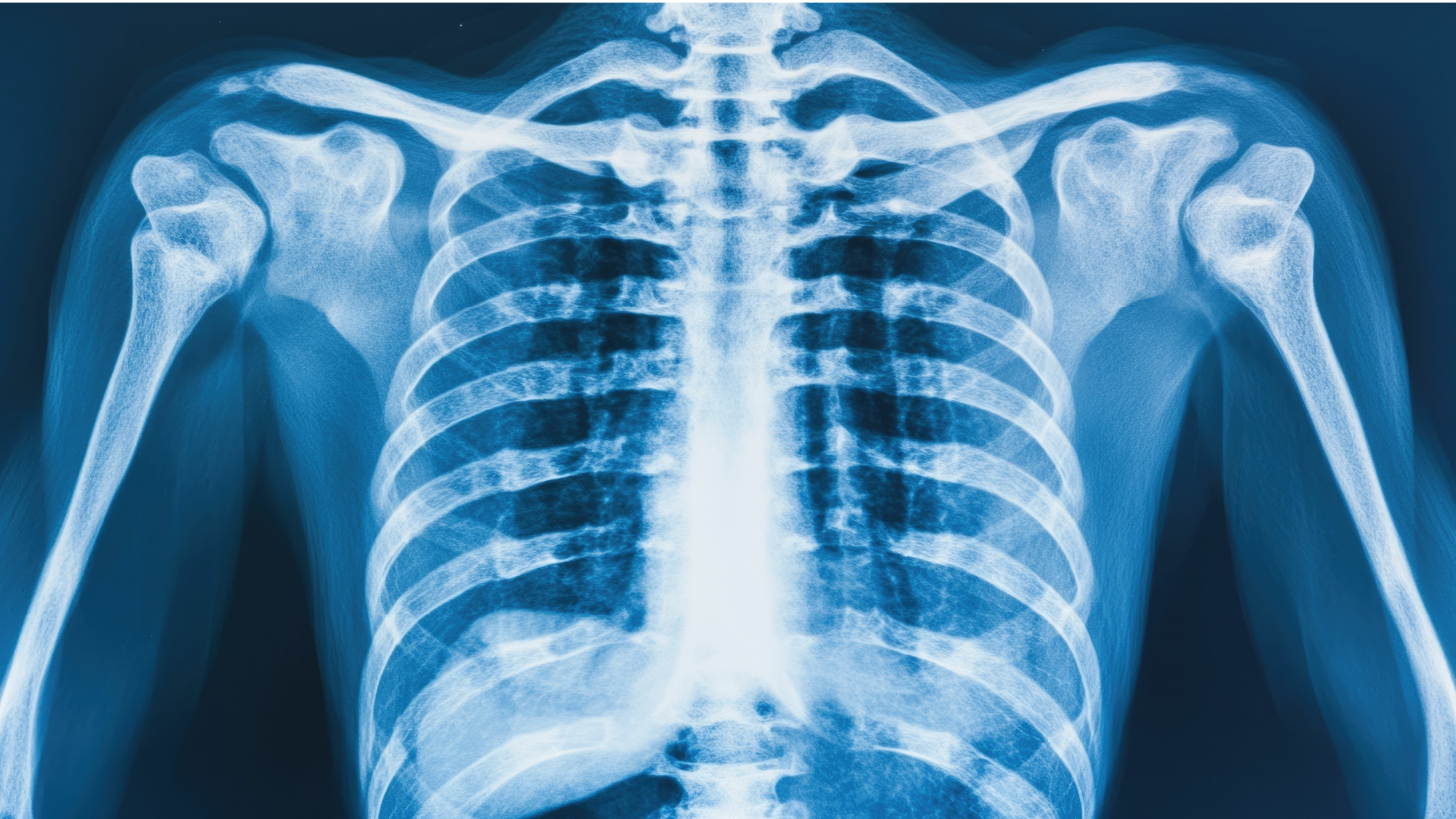 the image of a generic chest x-ray from the neck down the bottom of the ribcage