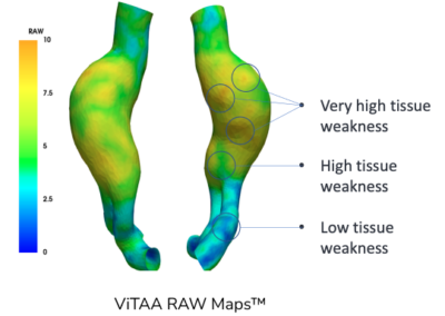 Protected: Predicting aortic vessel wall strength to provide effective treatment | ViTAA Medical